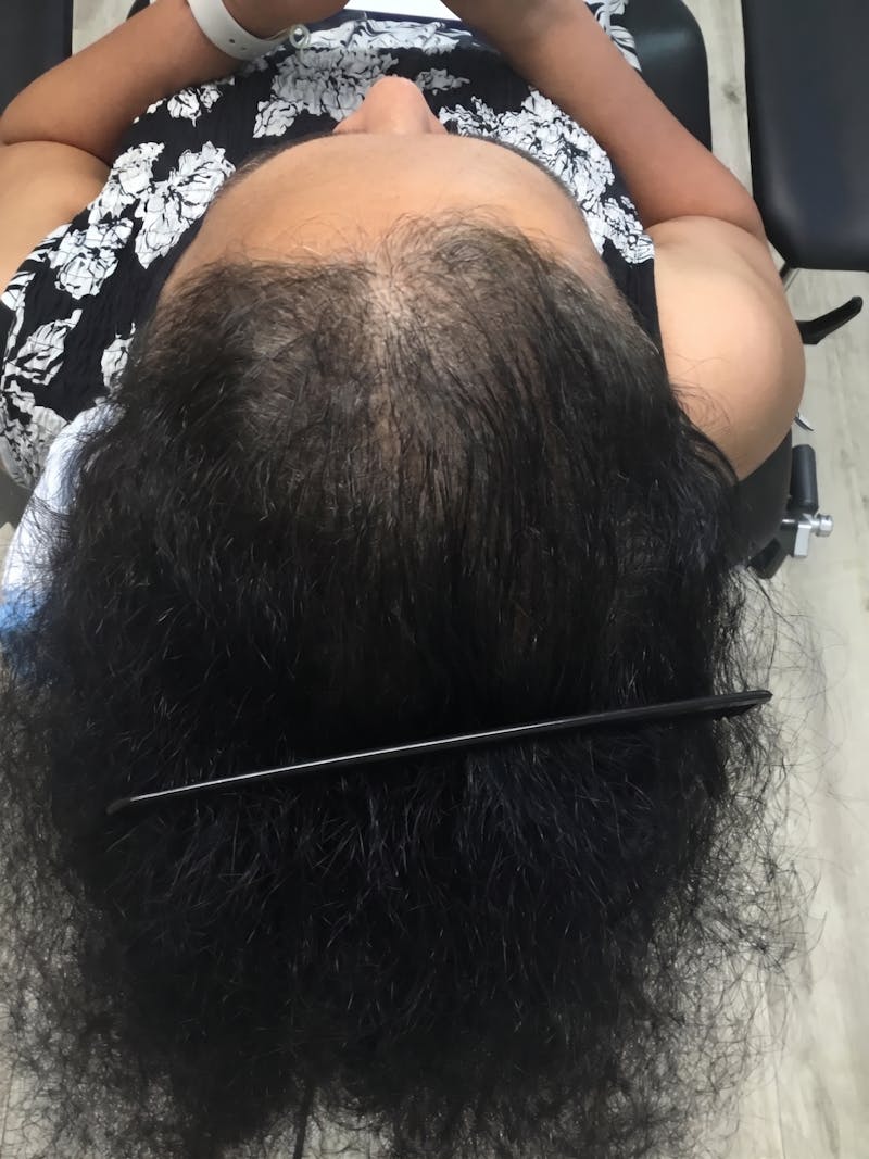 Painless PRP Before & After Gallery - Patient 223567 - Image 4