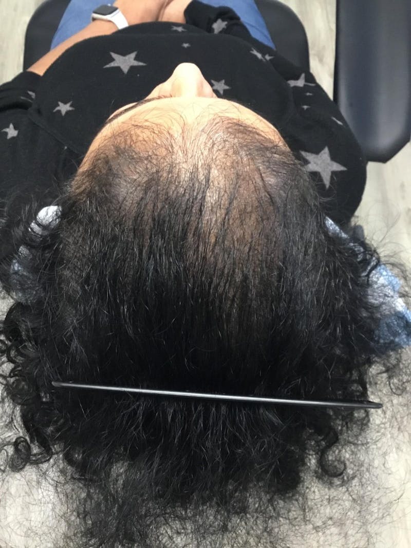 Painless PRP Before & After Gallery - Patient 223567 - Image 3
