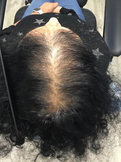 LaserCap HD+ Before & After Gallery - Patient 278685 - Image 1