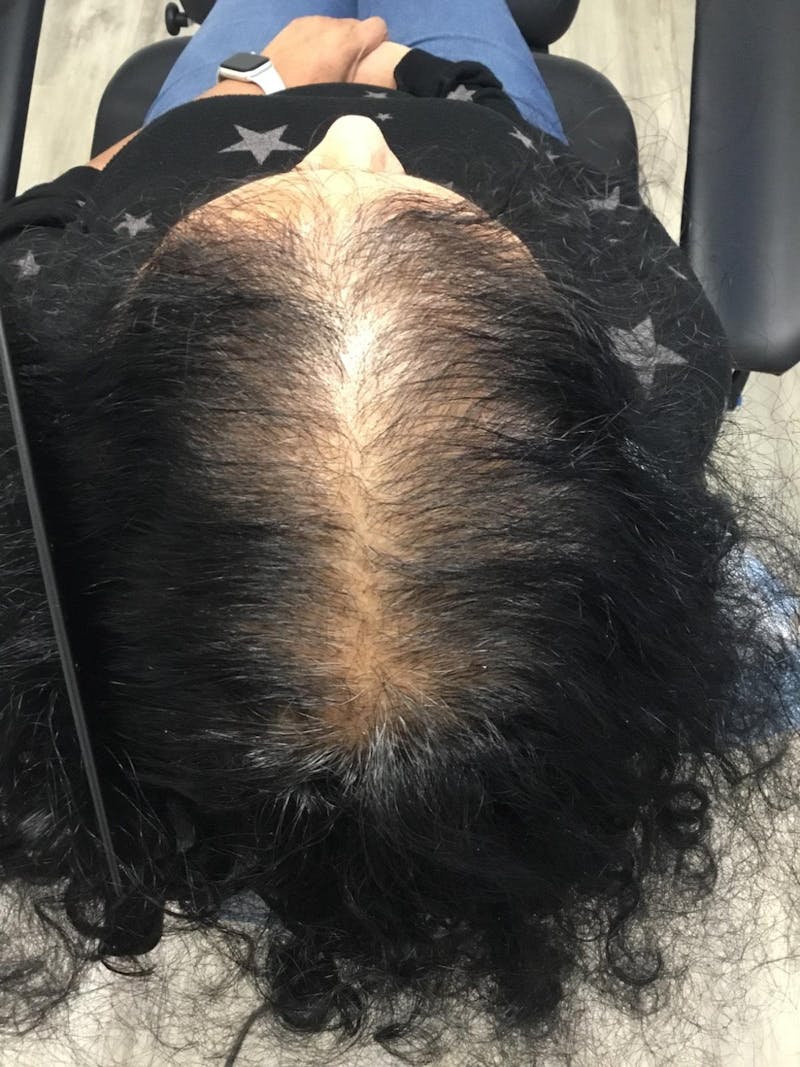 Painless PRP Before & After Gallery - Patient 223567 - Image 1