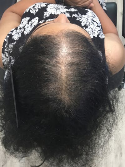 LaserCap HD+ Before & After Gallery - Patient 278685 - Image 2