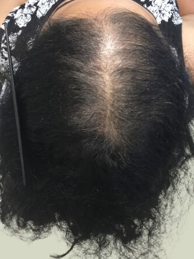 Low Level Laser Therapy Before & After Gallery - Patient 746784 - Image 2