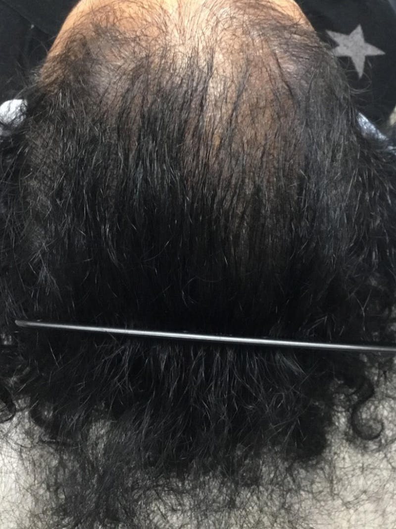 Androgenic Alopecia Before & After Gallery - Patient 279607 - Image 3