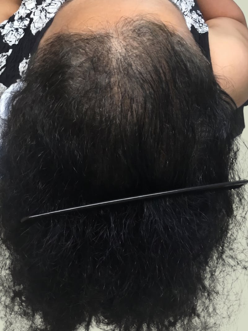 Androgenic Alopecia Before & After Gallery - Patient 279607 - Image 4