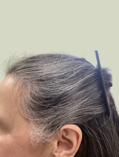 Low Level Laser Therapy Before & After Gallery - Patient 359184 - Image 2