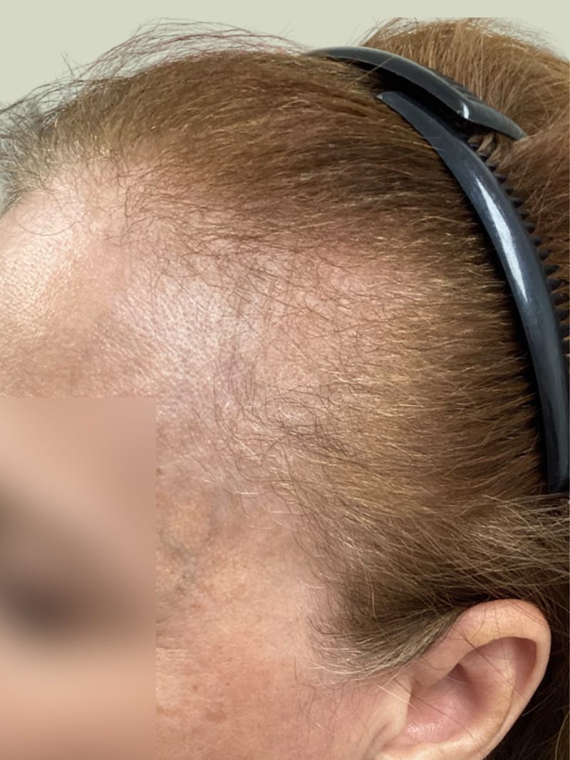 Androgenic Alopecia Before & After Gallery - Patient 143225 - Image 1