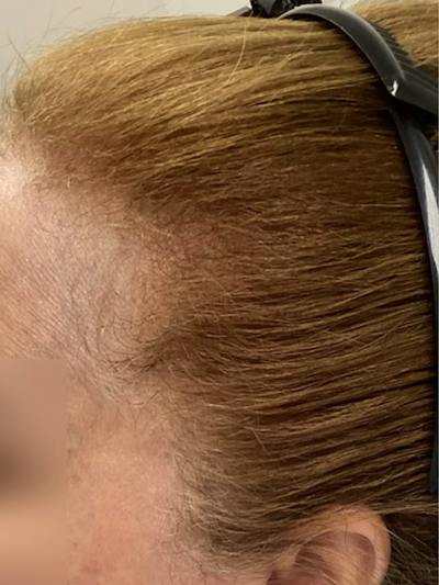 Androgenic Alopecia Before & After Gallery - Patient 143225 - Image 2