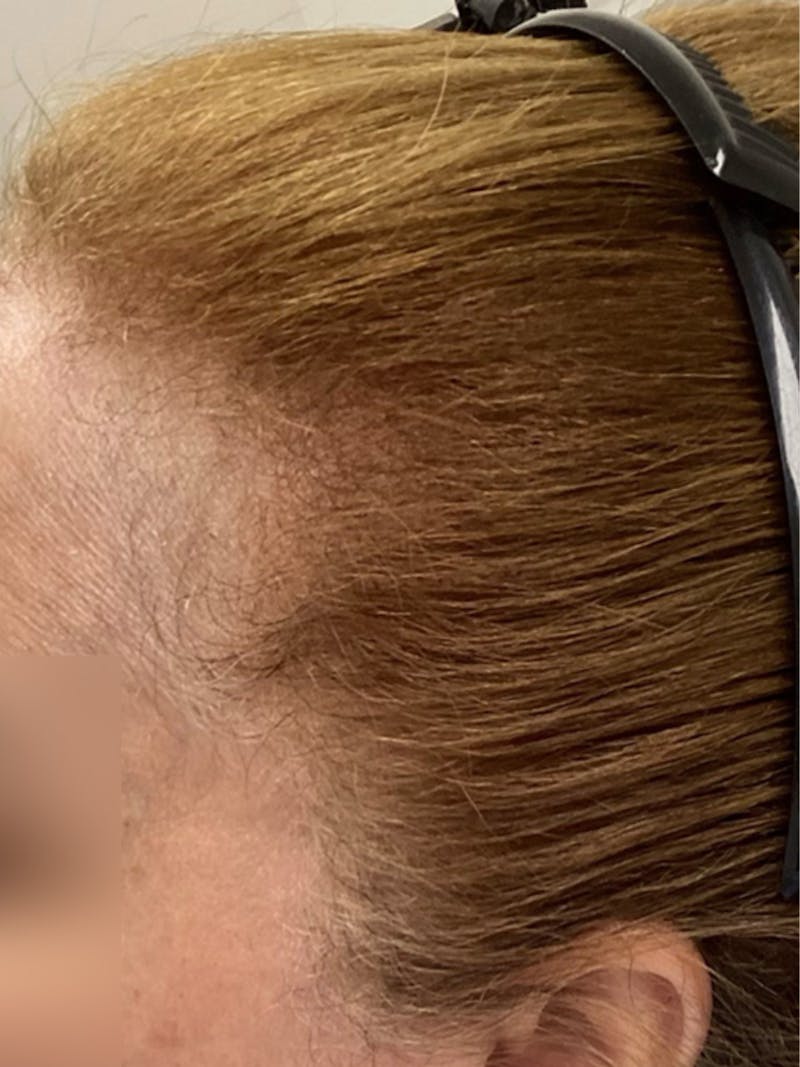 Androgenic Alopecia Before & After Gallery - Patient 143225 - Image 2