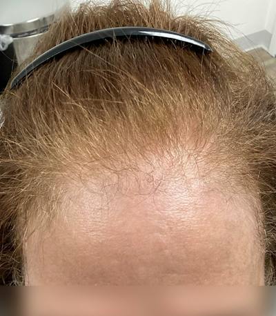 Androgenic Alopecia Before & After Gallery - Patient 262232 - Image 1