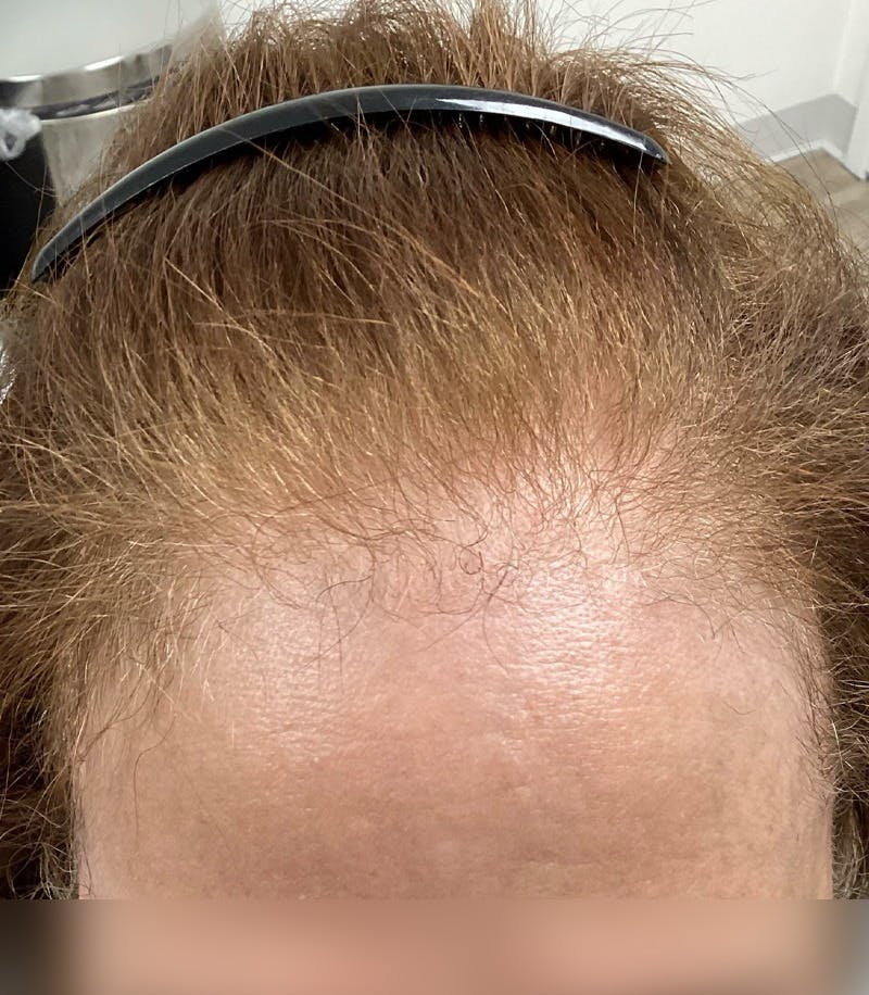 Androgenic Alopecia Before & After Gallery - Patient 262232 - Image 1