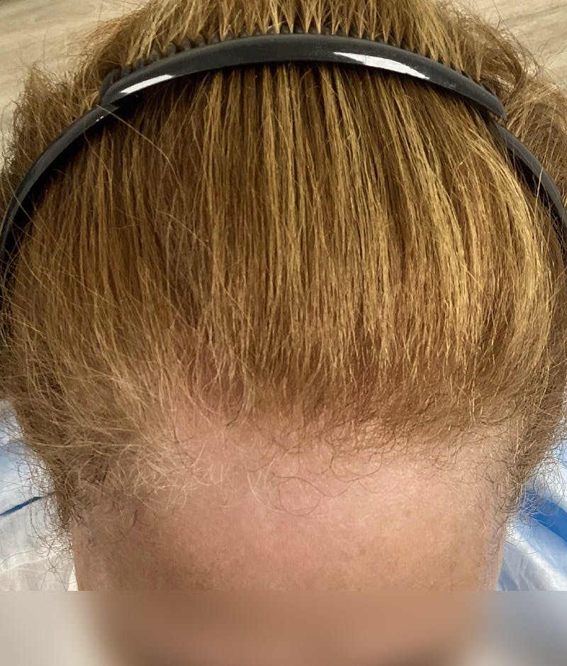 Androgenic Alopecia Before & After Gallery - Patient 262232 - Image 4