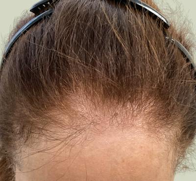Androgenic Alopecia Before & After Gallery - Patient 262232 - Image 2