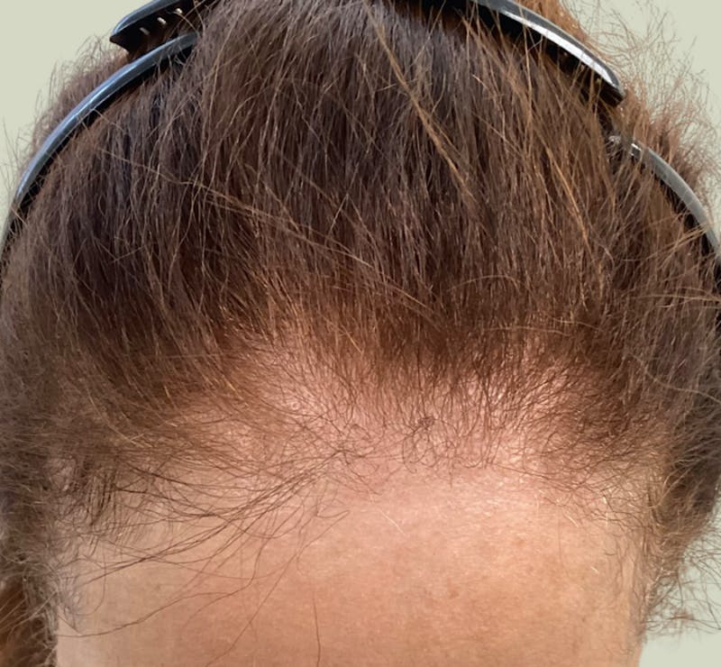 Androgenic Alopecia Before & After Gallery - Patient 262232 - Image 2
