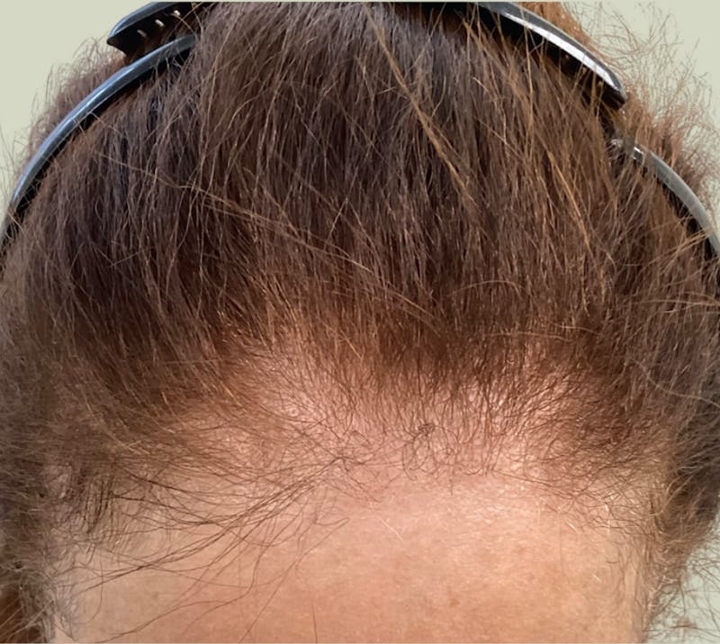 Androgenic Alopecia Before & After Gallery - Patient 262232 - Image 3
