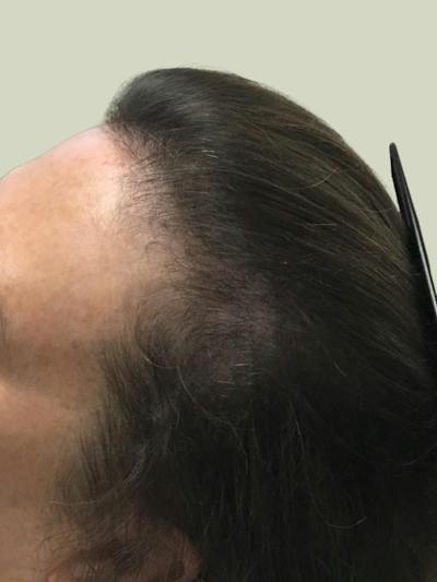 Low Level Laser Therapy Before & After Gallery - Patient 339678 - Image 2