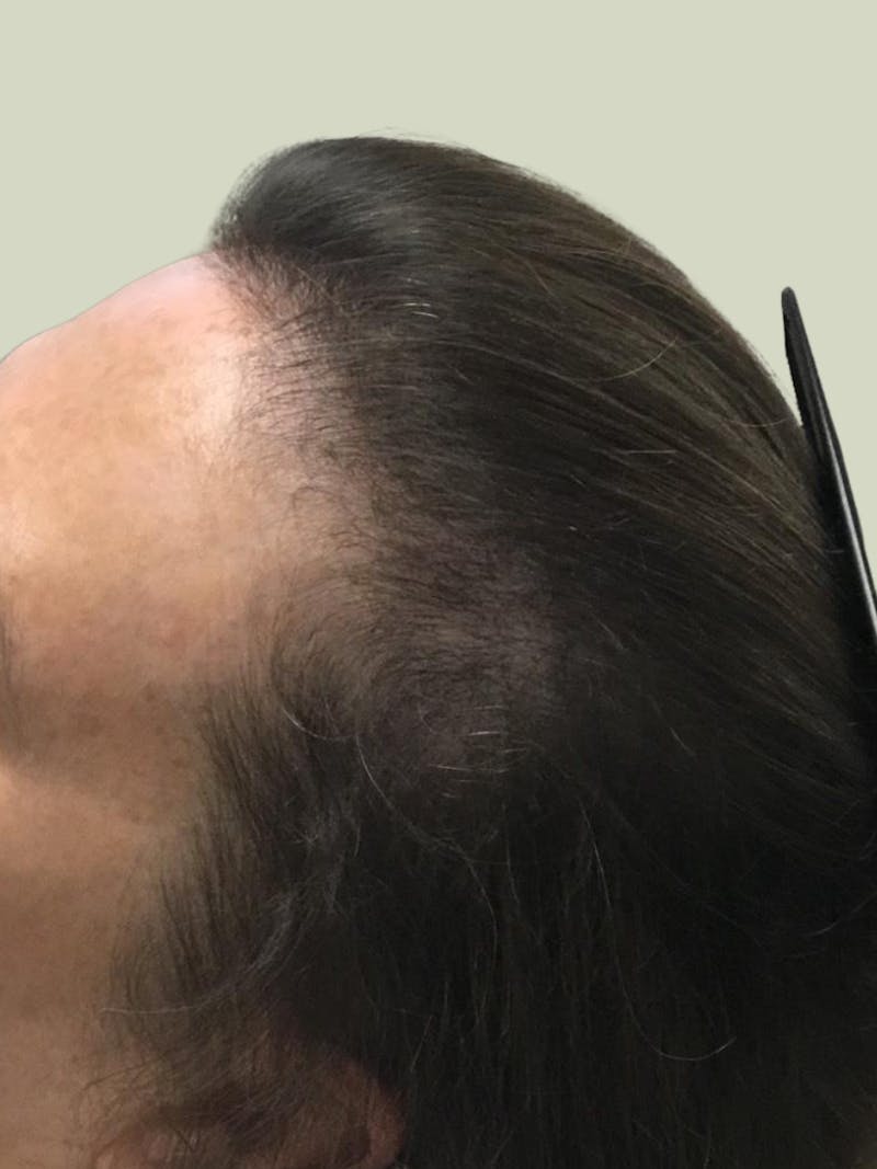 Vitamins & Supplements Before & After Gallery - Patient 118846 - Image 2
