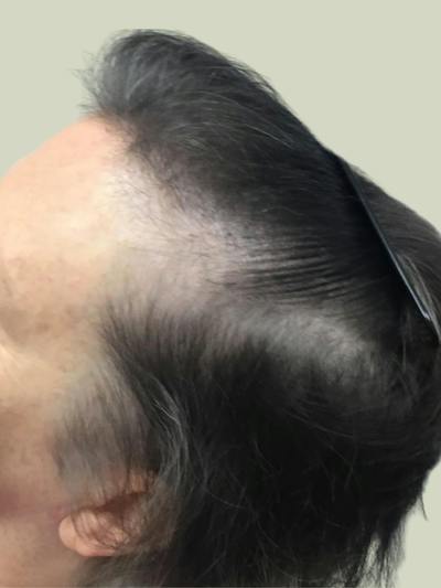 Low Level Laser Therapy Before & After Gallery - Patient 339678 - Image 1