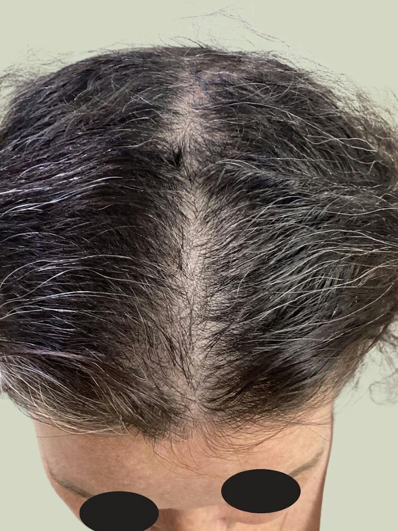 Alopecia Areata Before & After Gallery - Patient 170001 - Image 2