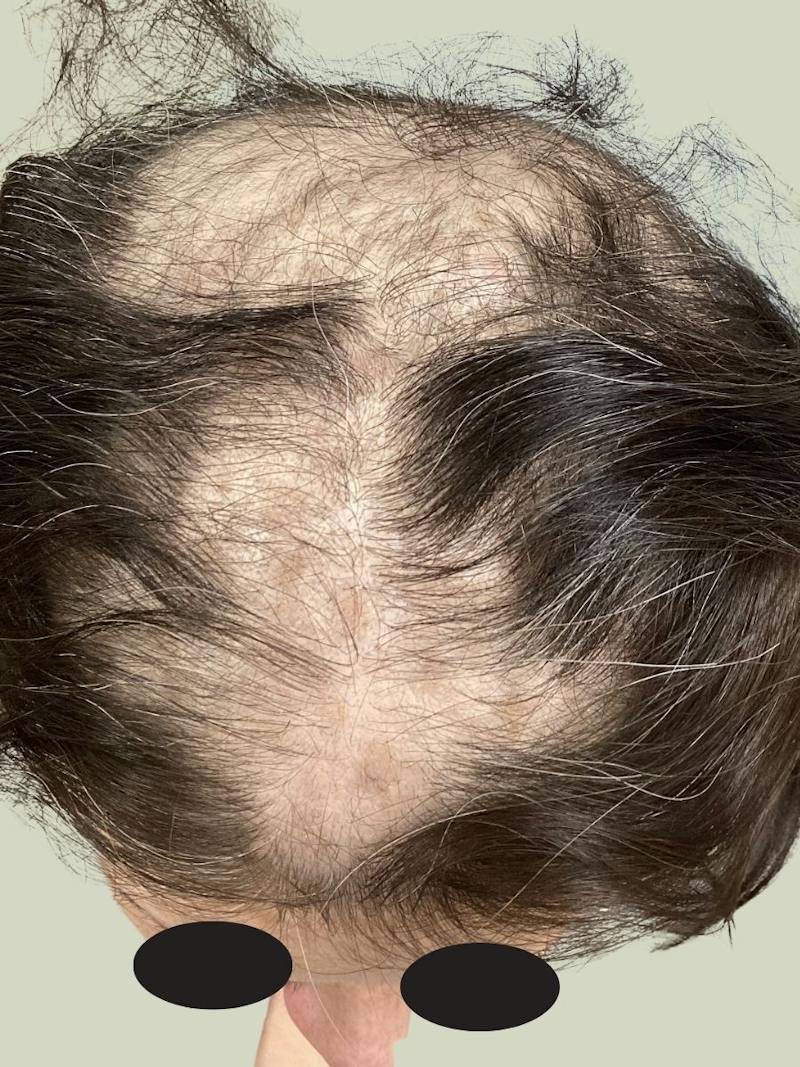 Alopecia Areata Before & After Gallery - Patient 170001 - Image 1