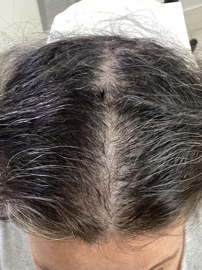 hair patient