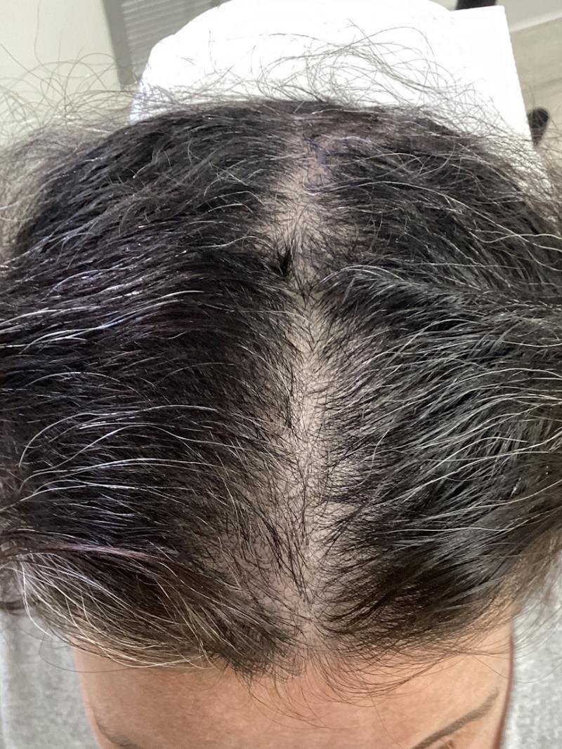 LaserCap HD+ Before & After Gallery - Patient 372363 - Image 2