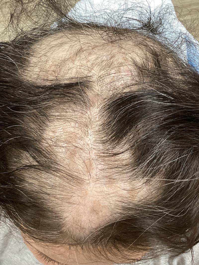 LaserCap HD+ Before & After Gallery - Patient 372363 - Image 1
