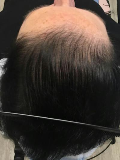 Painless PRP Before & After Gallery - Patient 347294 - Image 2