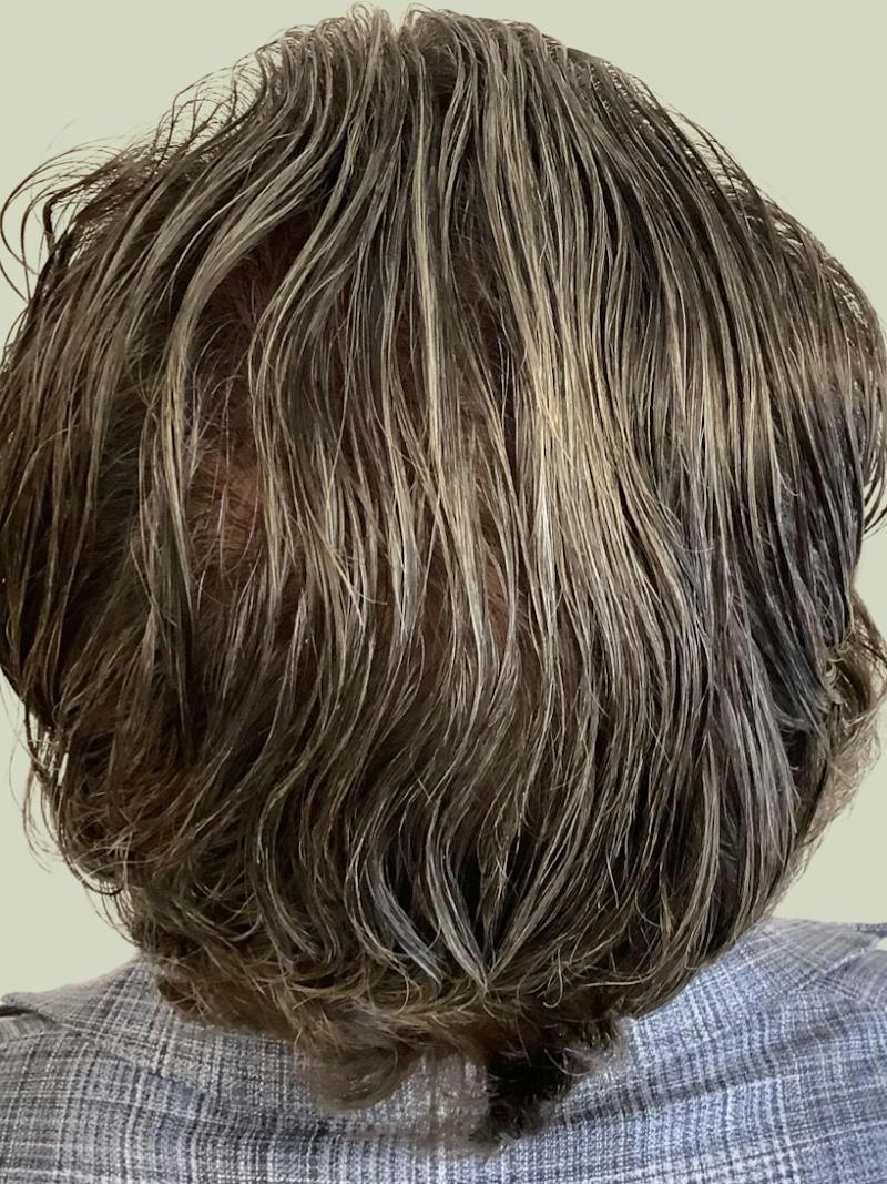 Male Hair Transplants Before & After Gallery - Patient 295919 - Image 2