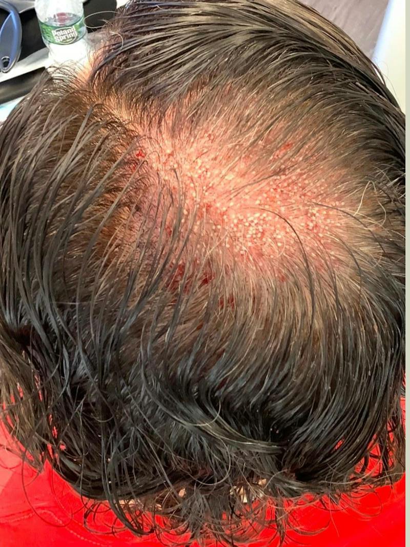 Male Hair Transplants Before & After Gallery - Patient 295919 - Image 1