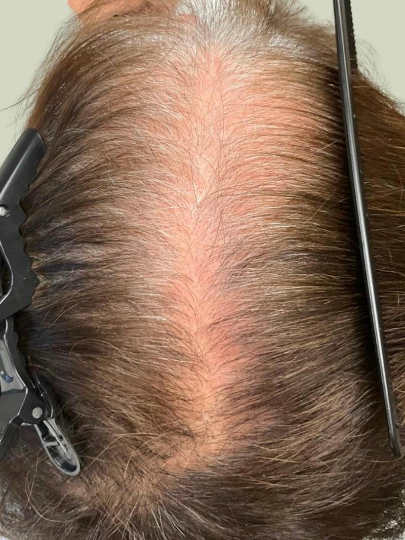Painless PRP Before & After Gallery - Patient 217292 - Image 1