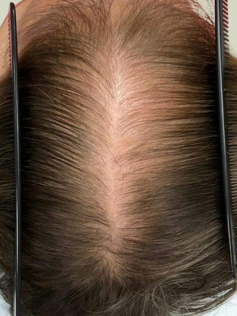 Painless PRP Before & After Gallery - Patient 217292 - Image 2