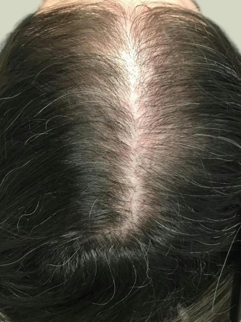 Androgenic Alopecia Before & After Gallery - Patient 301368 - Image 1