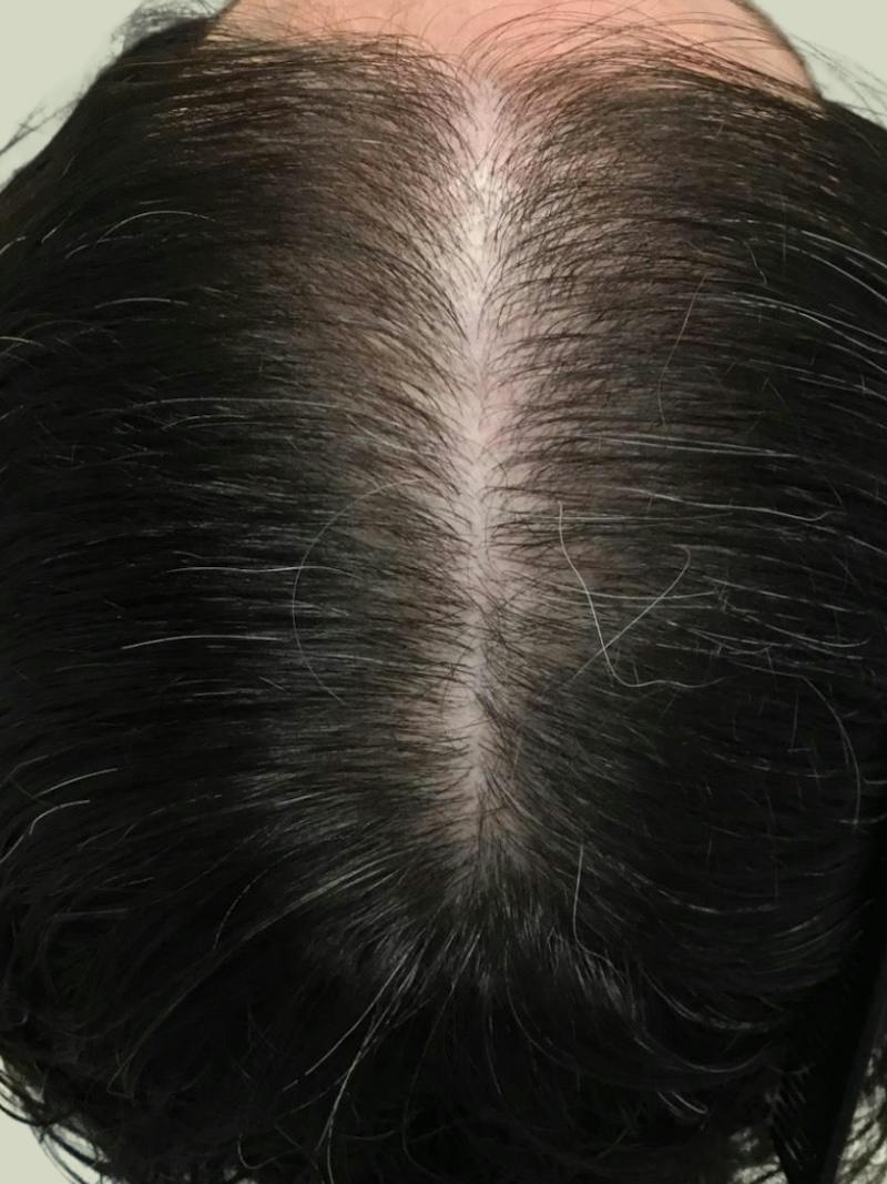 Androgenic Alopecia Before & After Gallery - Patient 301368 - Image 2