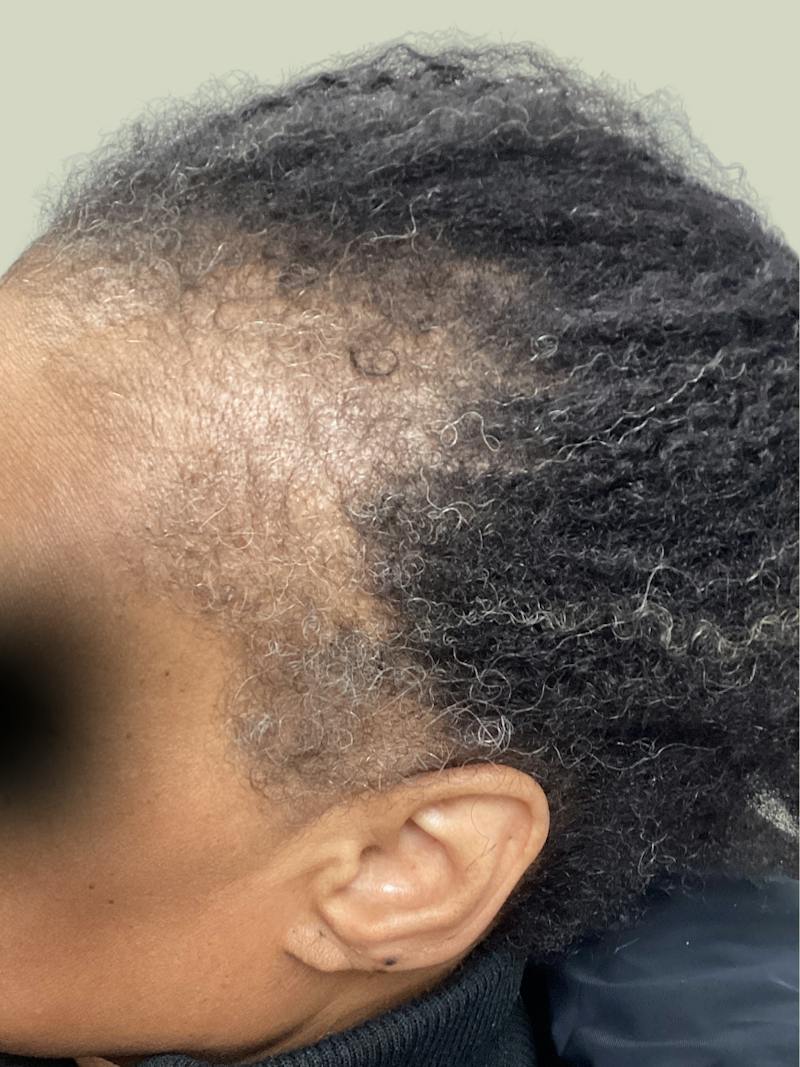 Medications Before & After Gallery - Patient 137378 - Image 1