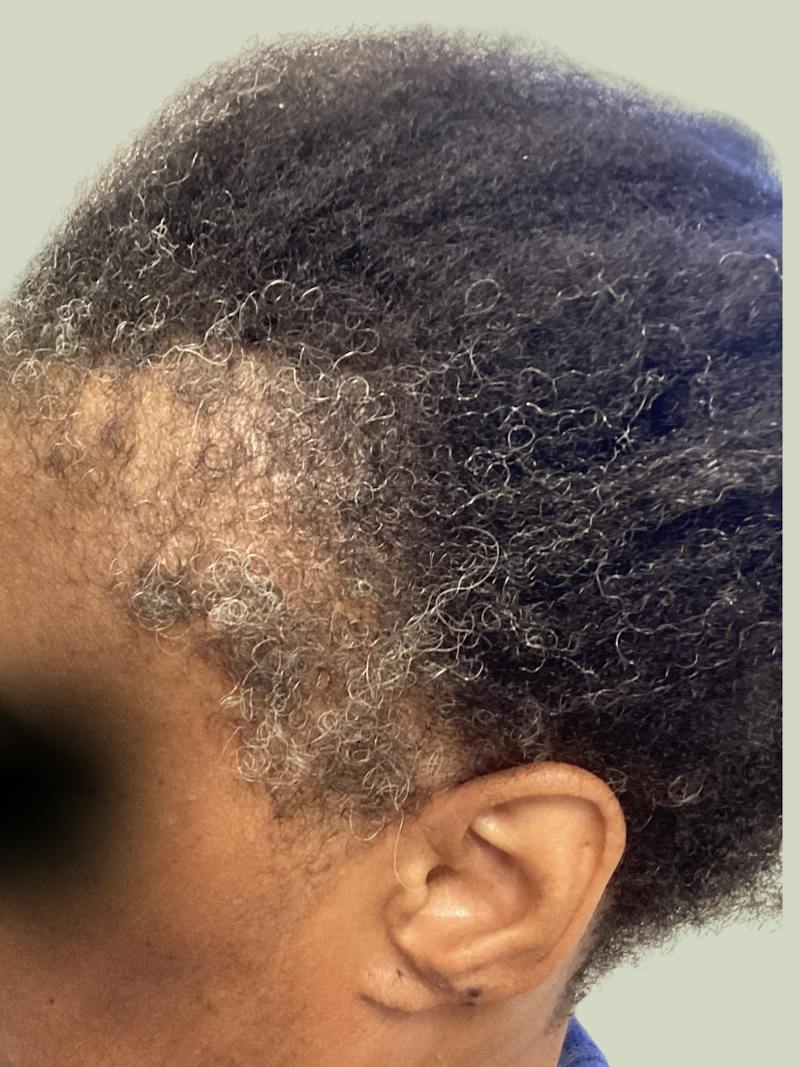 Medications Before & After Gallery - Patient 137378 - Image 2