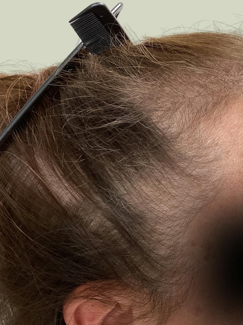 Optimal Platelet Concentration™ Therapy Before & After Gallery - Patient 116894 - Image 1