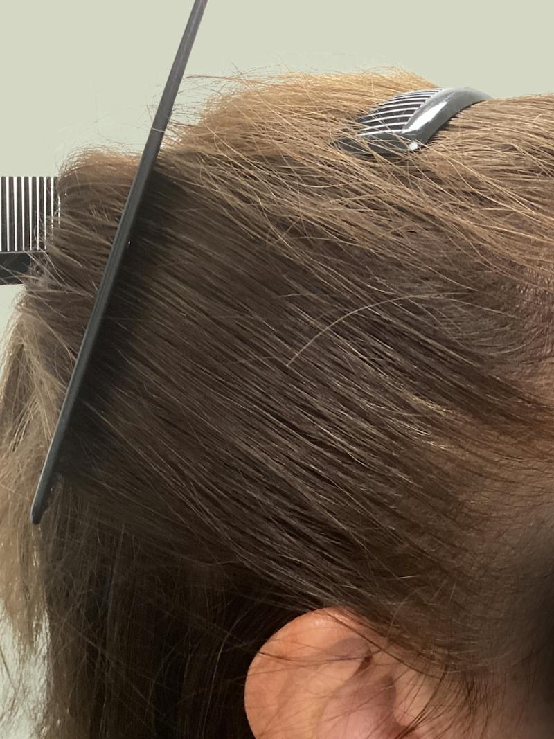 Optimal Platelet Concentration™ Therapy Before & After Gallery - Patient 116894 - Image 2