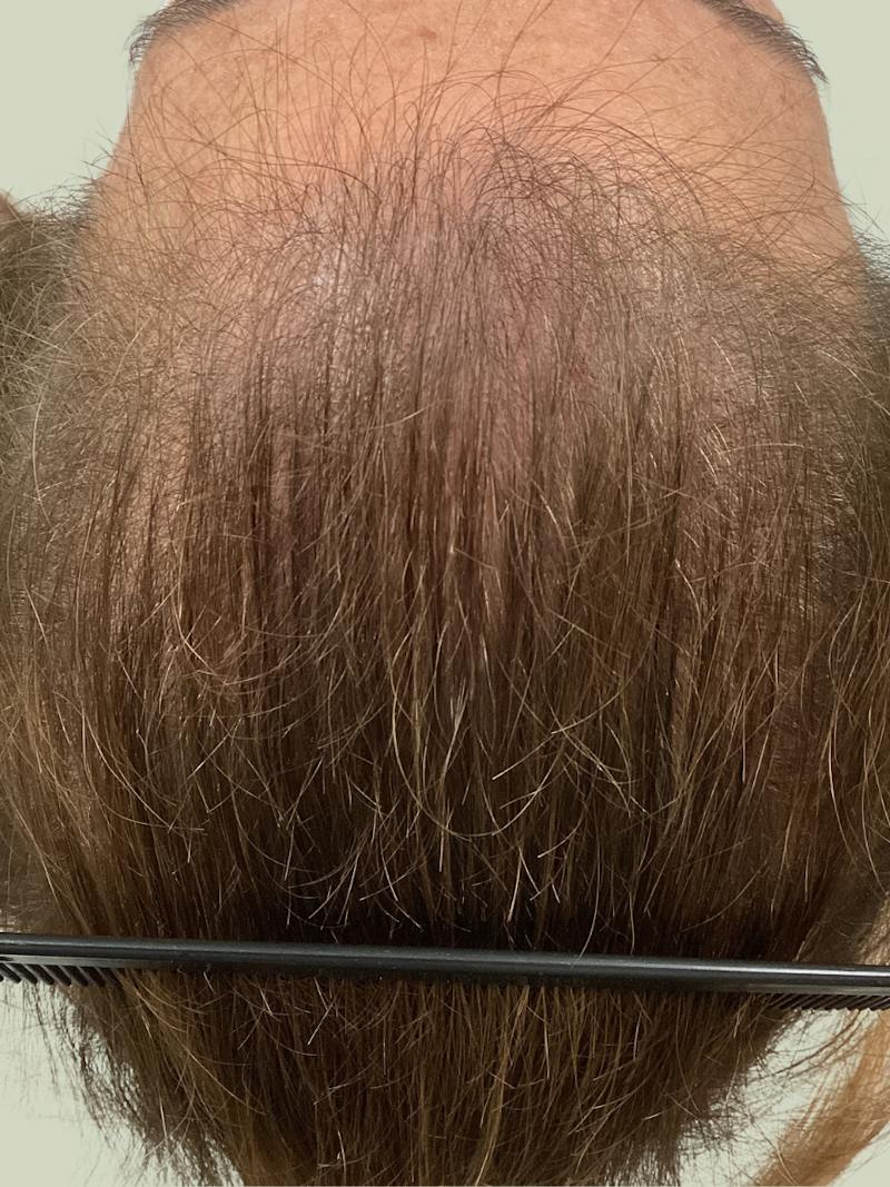 Optimal Platelet Concentration™ Therapy Before & After Gallery - Patient 116894 - Image 3