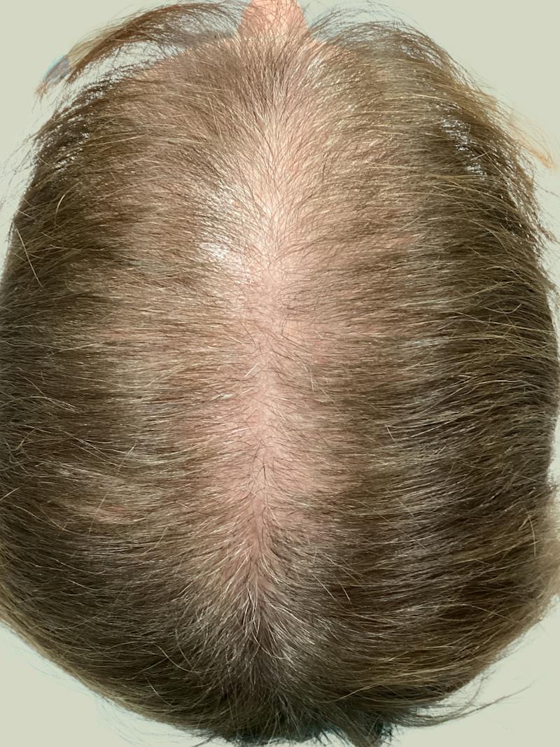 Optimal Platelet Concentration™ Therapy Before & After Gallery - Patient 116894 - Image 5