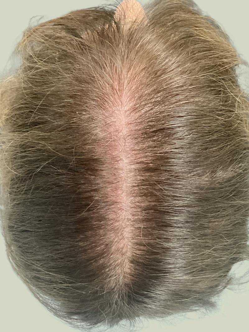 Optimal Platelet Concentration™ Therapy Before & After Gallery - Patient 116894 - Image 6