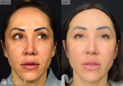 Forehead Reduction Before & After Gallery - Patient 357588 - Image 1