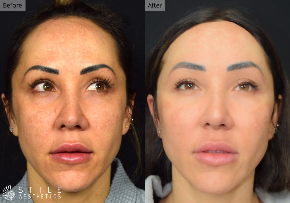 Forehead Reduction Before & After Gallery - Patient 357588 - Image 1