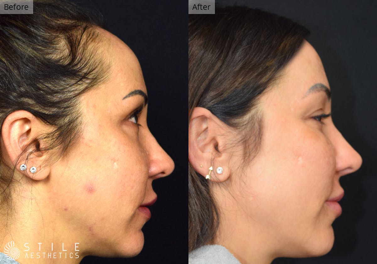 Forehead Reduction Before & After Gallery - Patient 357588 - Image 2