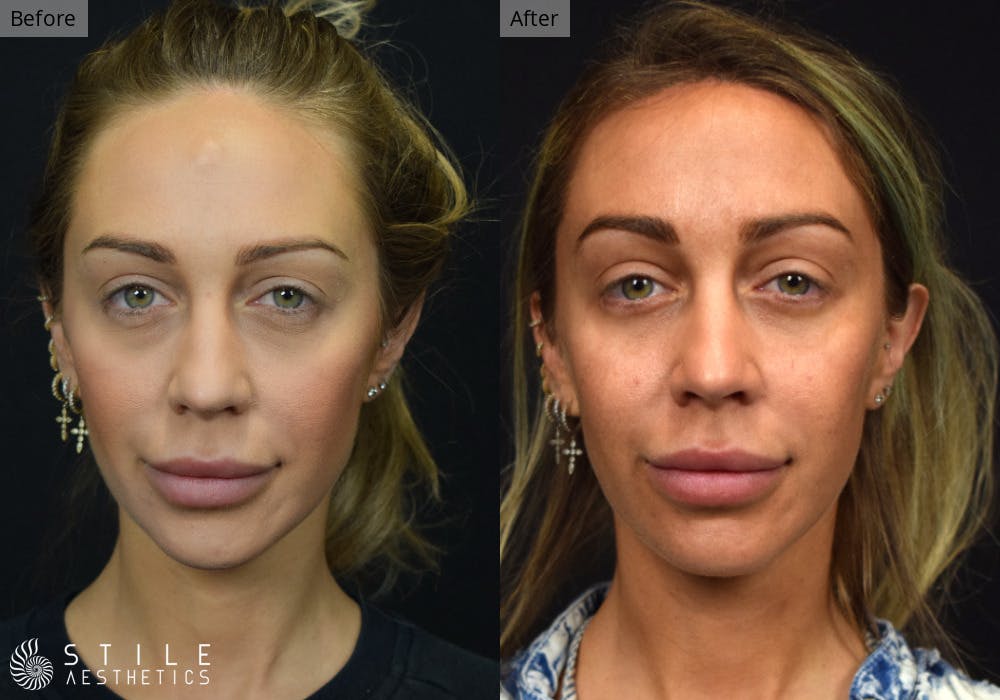 Forehead Reduction Before & After Gallery - Patient 212891 - Image 1