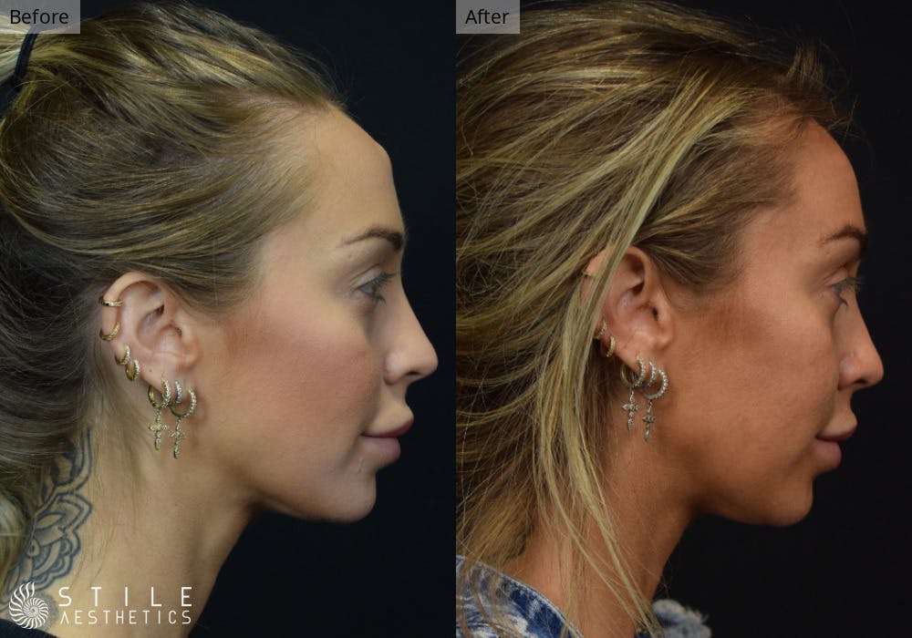Forehead Reduction Before & After Gallery - Patient 212891 - Image 2