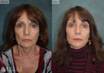 Facelift Before & After Gallery - Patient 328686 - Image 1