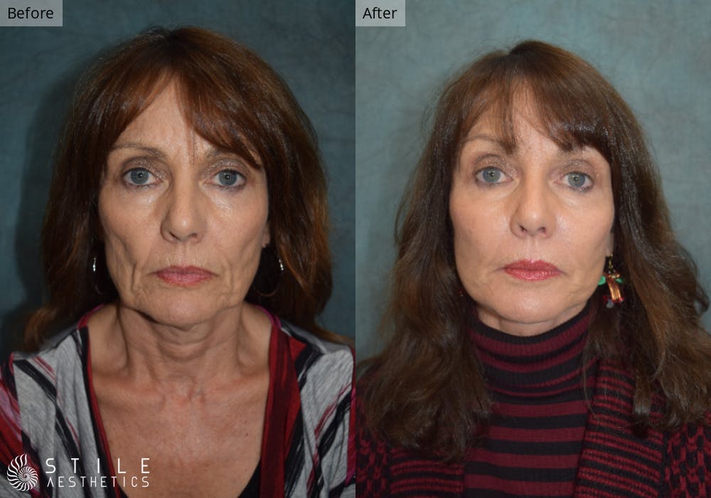Facelift Before & After Gallery - Patient 328686 - Image 1
