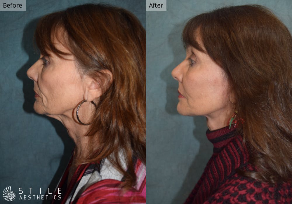Facelift Before & After Gallery - Patient 328686 - Image 2