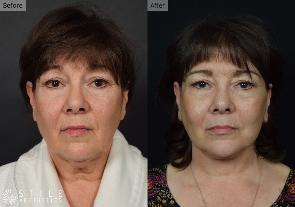 Facelift Before & After Gallery - Patient 186258 - Image 1
