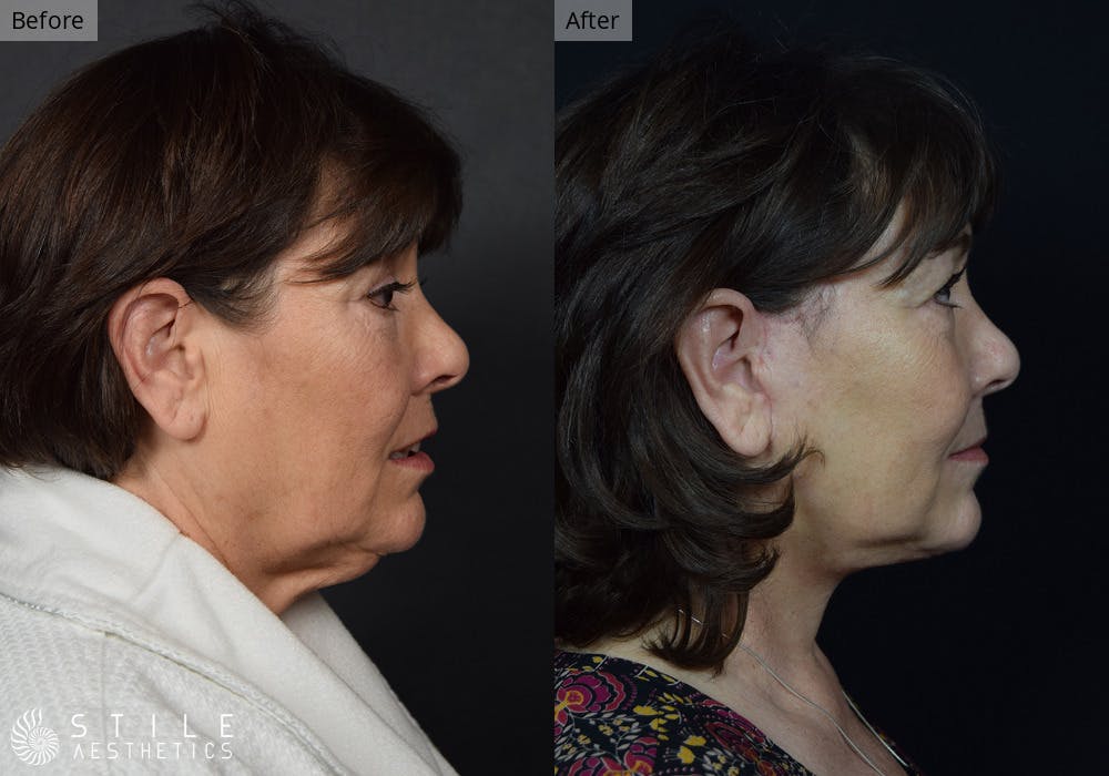 Facelift Before & After Gallery - Patient 186258 - Image 2